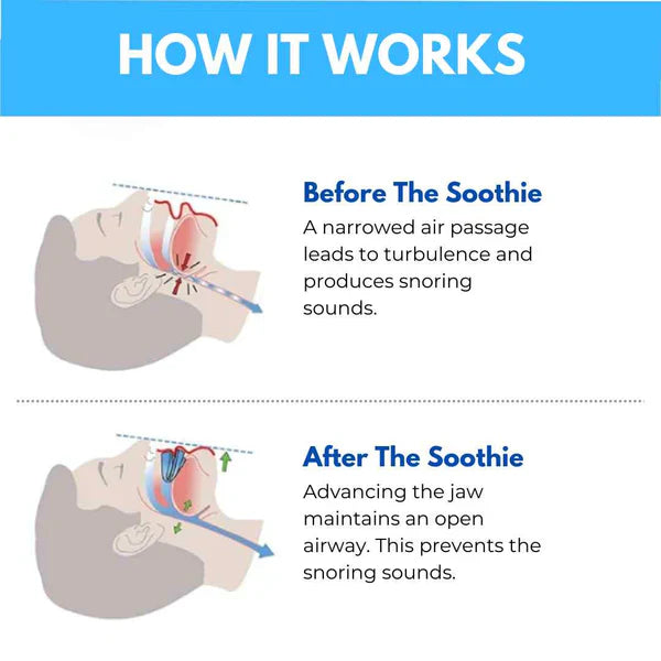 Snore Free+ Anti-Snoring Mouthpiece Universal Size