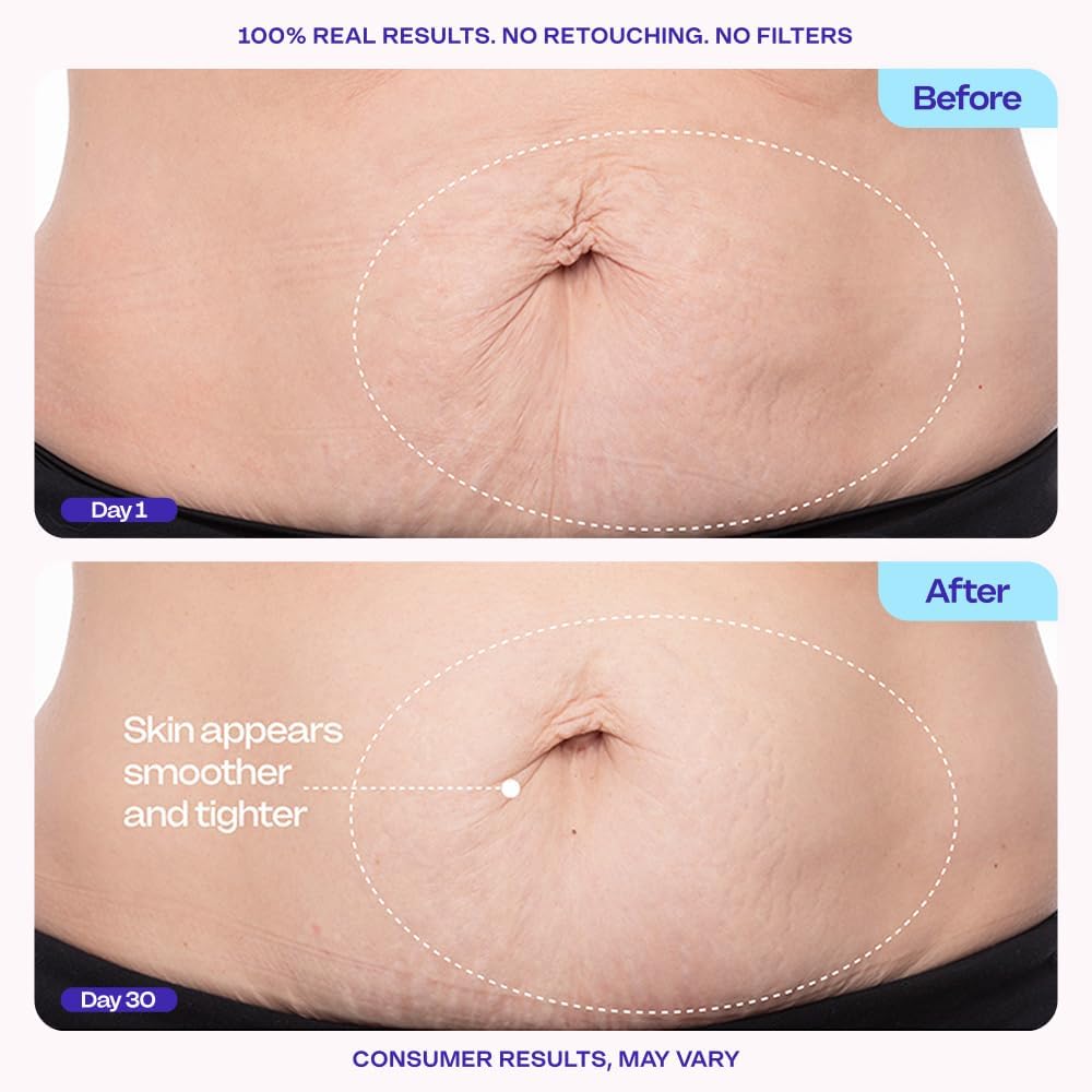 Pryxo™Belly Firming Cream – Cellulite + Stretch Marks