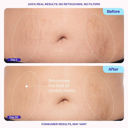 Pryxo™Belly Firming Cream – Cellulite + Stretch Marks