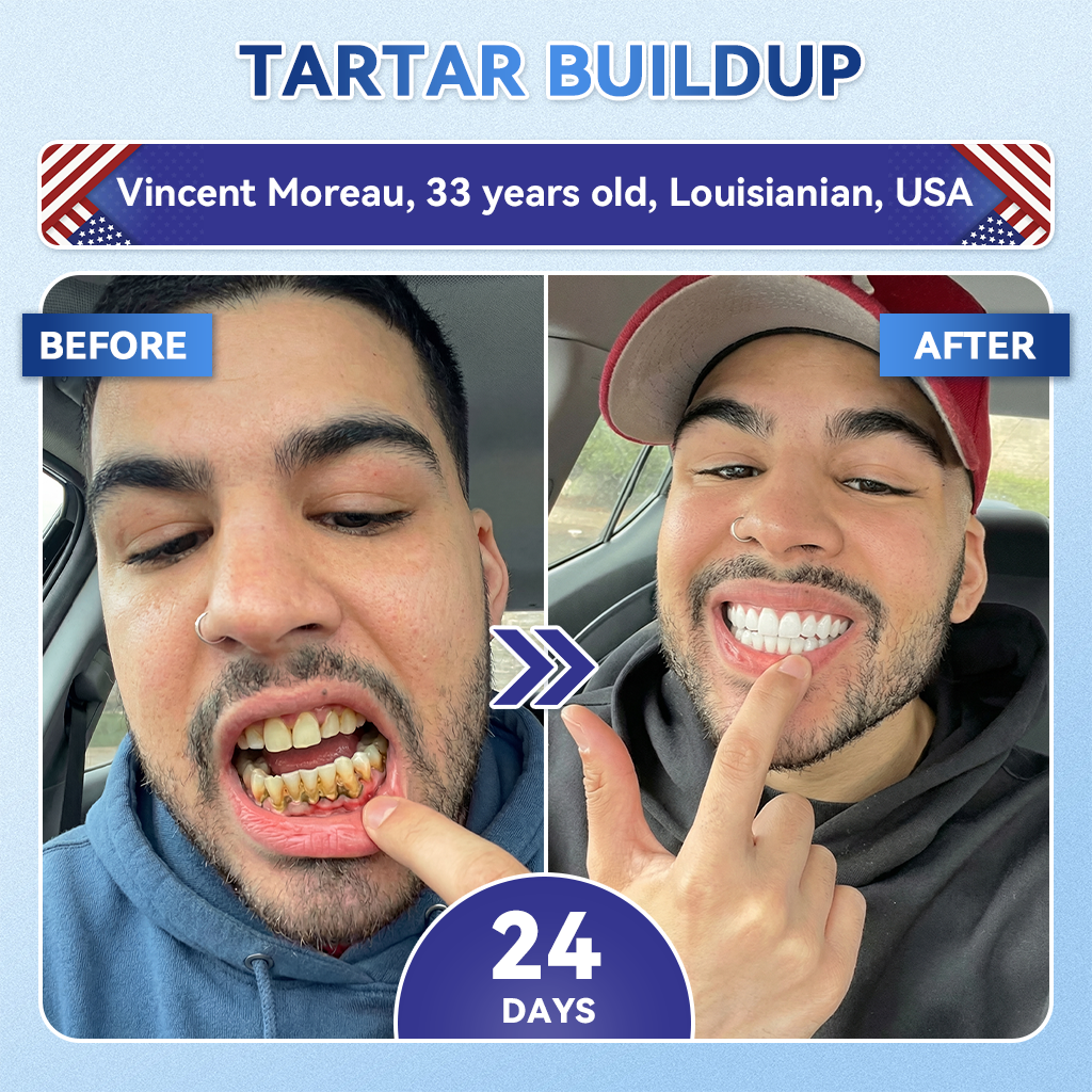 Your Smile~ Borvexis® 🦷 Tideglusib Fast‑Dissolving Tooth & Gum Repair Oral Strips ✨ (𝟓-𝐢𝐧-𝟏 💎 𝐑𝐞𝐛𝐮𝐢𝐥𝐝 𝐄𝐧𝐚𝐦𝐞𝐥 & 𝐃𝐞𝐧𝐭𝐢𝐧 • 𝐒𝐭𝐫𝐞𝐧𝐠𝐭𝐡𝐞𝐧 𝐆𝐮𝐦𝐬 • 𝐄𝐫𝐚𝐝𝐢𝐜𝐚𝐭𝐞 𝐓𝐚𝐫𝐭𝐚𝐫 & 𝐎𝐝𝐨𝐫 • 𝐖𝐡𝐢𝐭𝐞𝐧𝐢𝐧𝐠 • 𝐒𝐭𝐨𝐩 𝐓𝐨𝐨𝐭𝐡 𝐒𝐞𝐧𝐬𝐢𝐭𝐢𝐯𝐢𝐭𝐲)