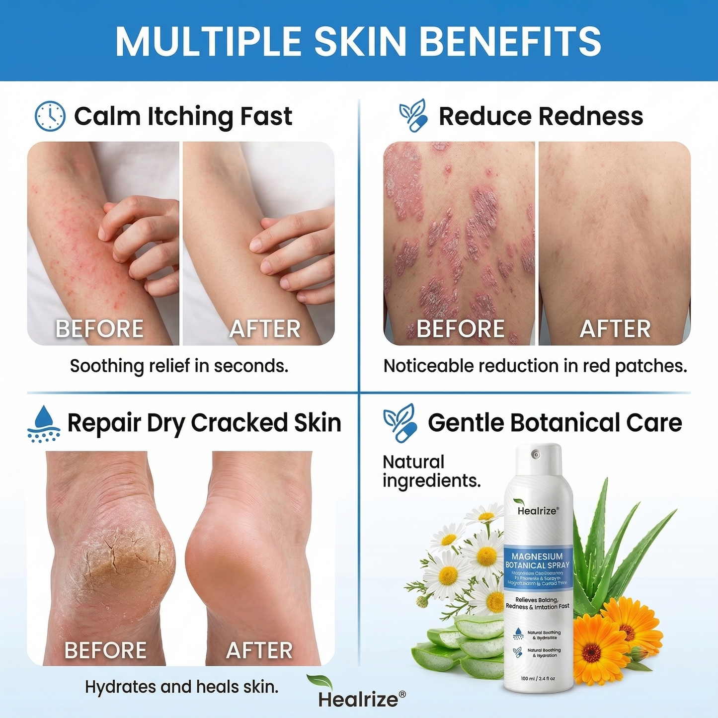 🌿Healrize® Magnesium Botanical Spray – Advanced Skin Recovery for Psoriasis & Eczema | Rapid Soothing, Steroid-Free