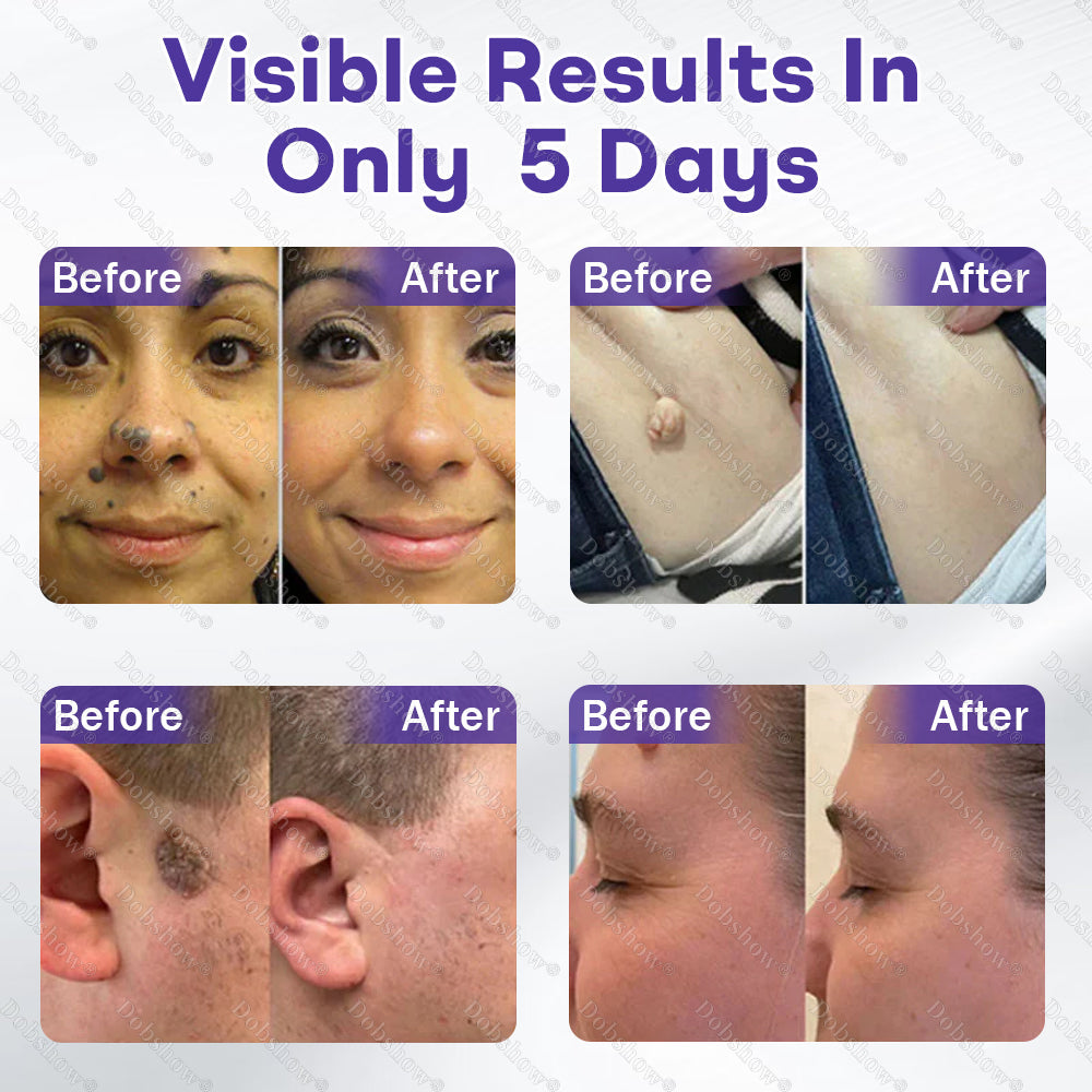 ✨Dobshow® Wart and mole removal microneedle patch