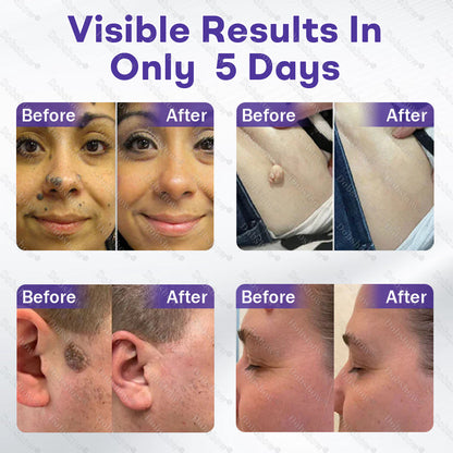 ✨Dobshow® Wart and mole removal microneedle patch