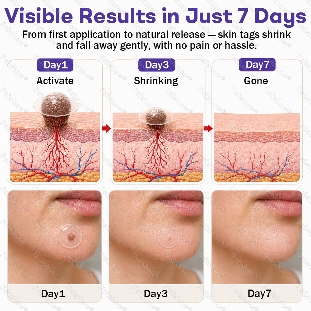 ✨Dobshow® Wart and mole removal microneedle patch