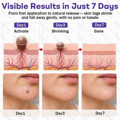 ✨Dobshow® Wart and mole removal microneedle patch