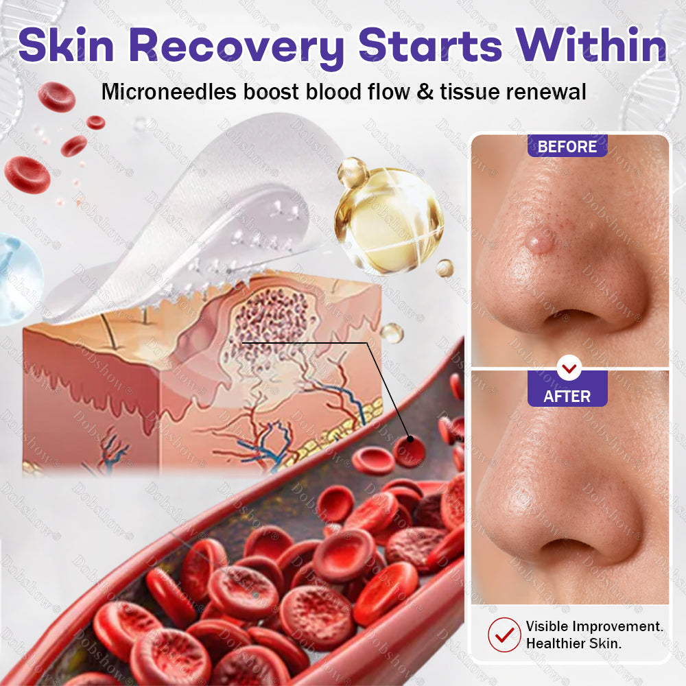 ✨Dobshow® Wart and mole removal microneedle patch