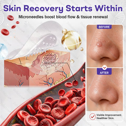 ✨Dobshow® Wart and mole removal microneedle patch