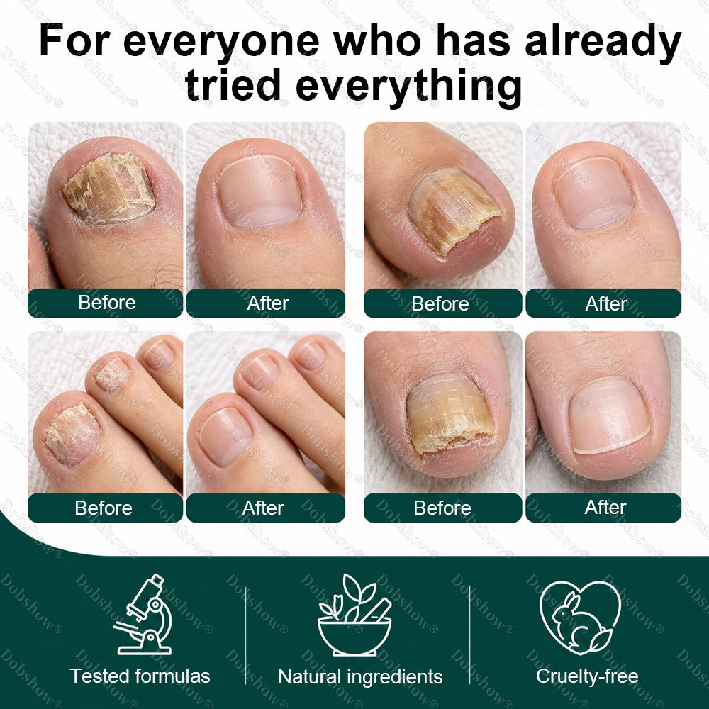 𝗛𝗲𝗮𝗹𝗿𝗶𝘇𝗲® 𝗡𝗮𝗶𝗹 𝗙𝘂𝗻𝗴𝘂𝘀 𝗧𝗿𝗲𝗮𝘁𝗺𝗲𝗻𝘁 𝗣𝗲𝗻