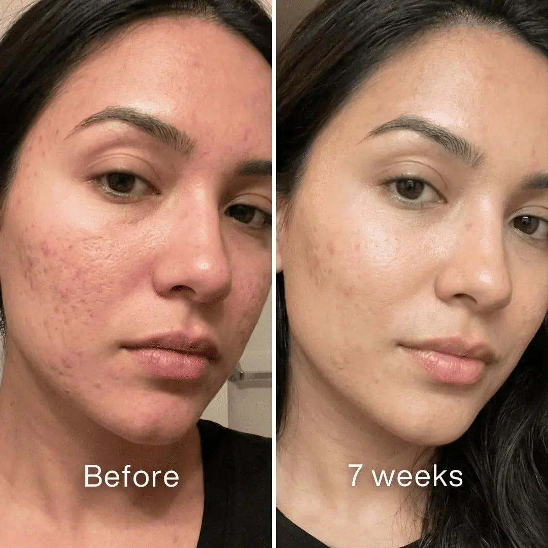 Clinical Acne Scar Repair Stick（The second one is 40% off!）