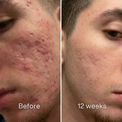 Clinical Acne Scar Repair Stick（The second one is 40% off!）